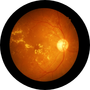 age-related-macular-degeneration-2