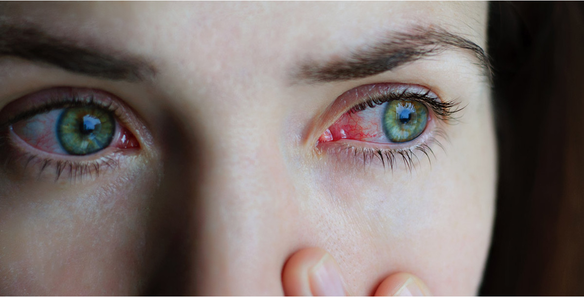 conjunctivitis